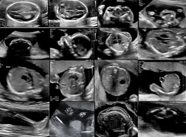 Anomaly Scan Ultrasound Images